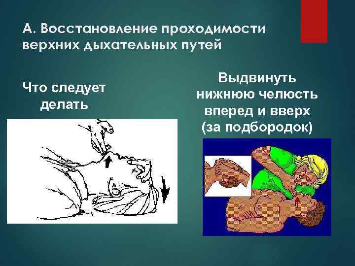 А. Восстановление проходимости верхних дыхательных путей Что следует делать Выдвинуть нижнюю челюсть вперед и