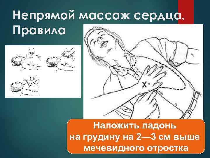 Непрямой массаж сердца. Правила : Наложить ладонь на грудину на 2— 3 см выше