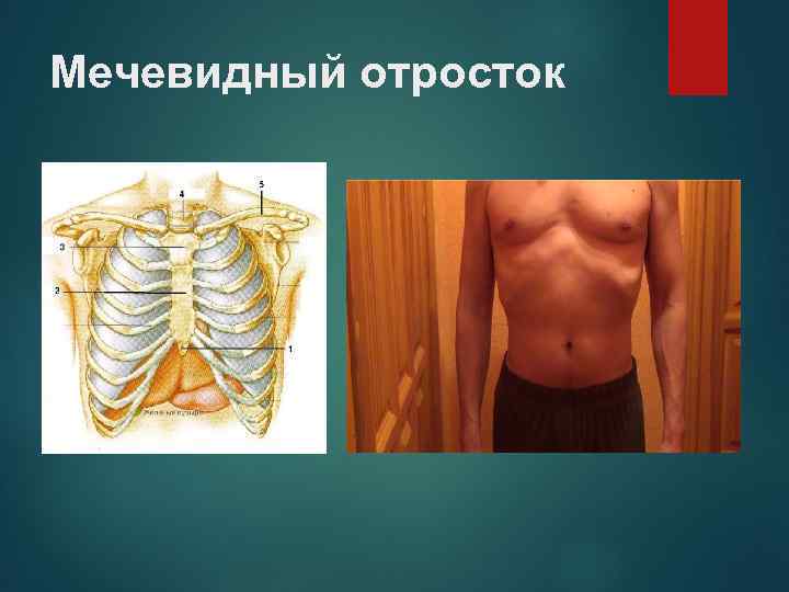 Мечевидный отросток 