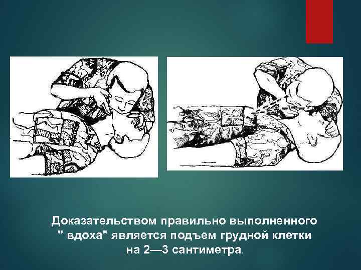 Доказательством правильно выполненного " вдоха" является подъем грудной клетки на 2— 3 сантиметра. 