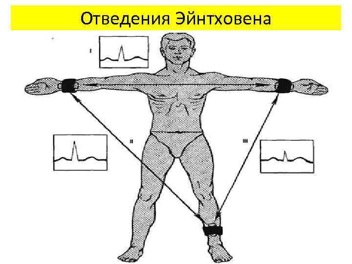 Отведения Эйнтховена 