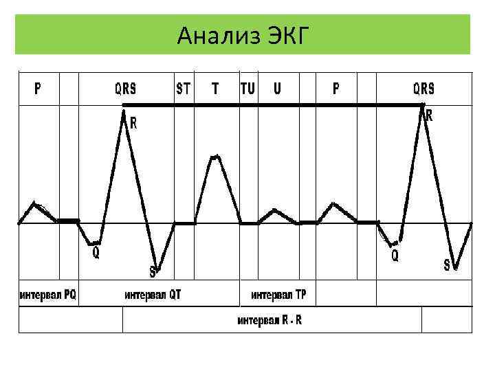 Анализ ЭКГ 