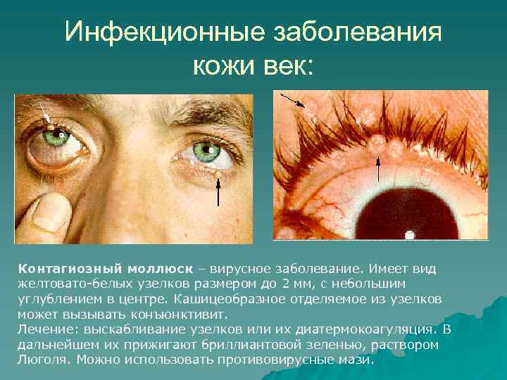 Инфекционные заболевания кожи век: Контагиозный моллюск – вирусное заболевание. Имеет вид желтовато-белых узелков размером