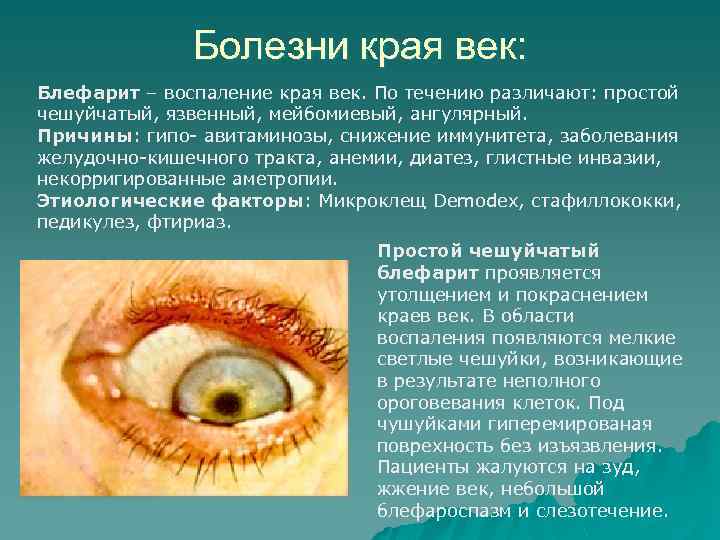 Болезни края век: Блефарит – воспаление края век. По течению различают: простой чешуйчатый, язвенный,