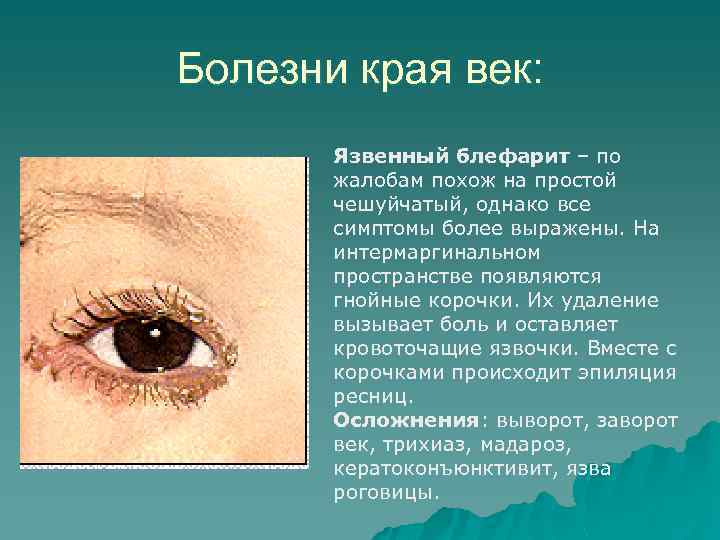Болезни края век: Язвенный блефарит – по жалобам похож на простой чешуйчатый, однако все