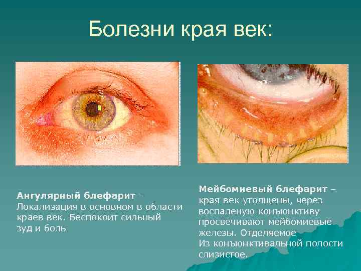 Болезни края век: Ангулярный блефарит – Локализация в основном в области краев век. Беспокоит