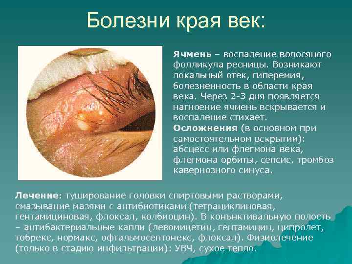 Болезни края век: Ячмень – воспаление волосяного фолликула ресницы. Возникают локальный отек, гиперемия, болезненность