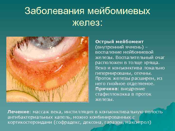 Заболевания мейбомиевых желез: Острый мейбомеит (внутренний ячмень) – воспаление мейбомиевой железы. Воспалительный очаг расположен
