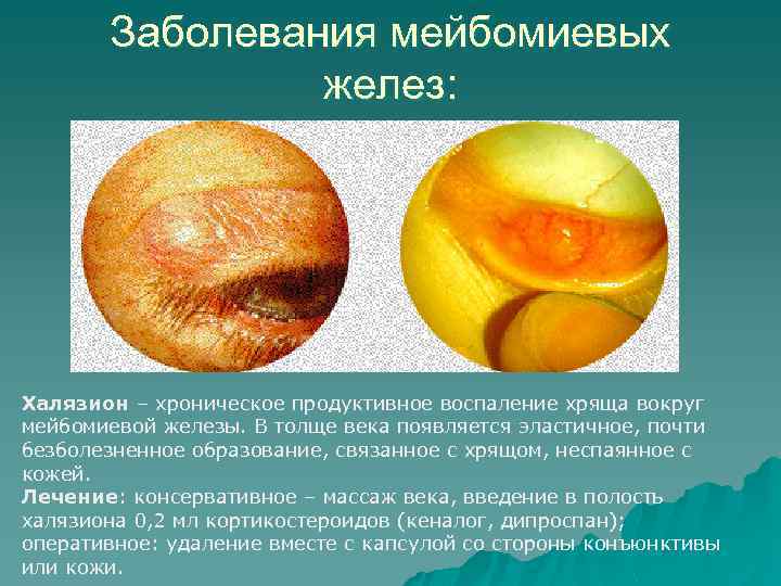 Заболевания мейбомиевых желез: Халязион – хроническое продуктивное воспаление хряща вокруг мейбомиевой железы. В толще
