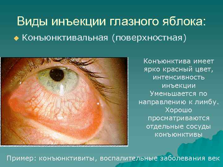 Виды инъекции глазного яблока: u Конъюнктивальная (поверхностная) Конъюнктива имеет ярко красный цвет, интенсивность инъекции
