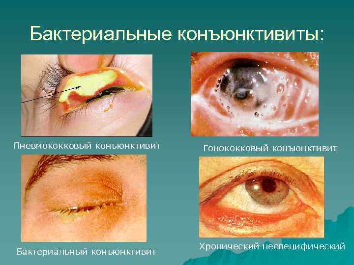 Бактериальные конъюнктивиты: Пневмококковый конъюнктивит Бактериальный конъюнктивит Гонококковый конъюнктивит Хронический неспецифический 