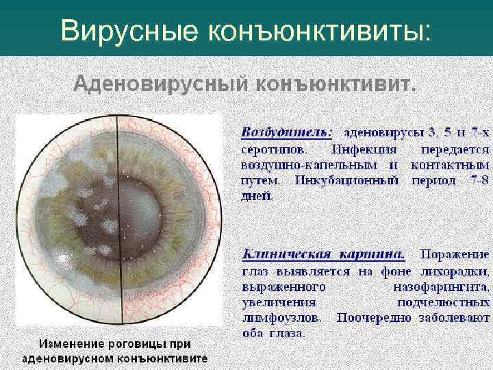 Вирусные конъюнктивиты: 