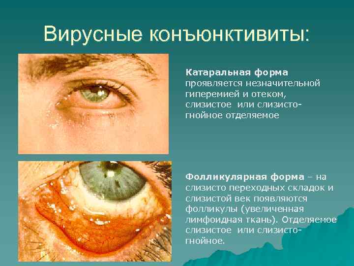 Вирусные конъюнктивиты: Катаральная форма проявляется незначительной гиперемией и отеком, слизистое или слизистогнойное отделяемое Фолликулярная