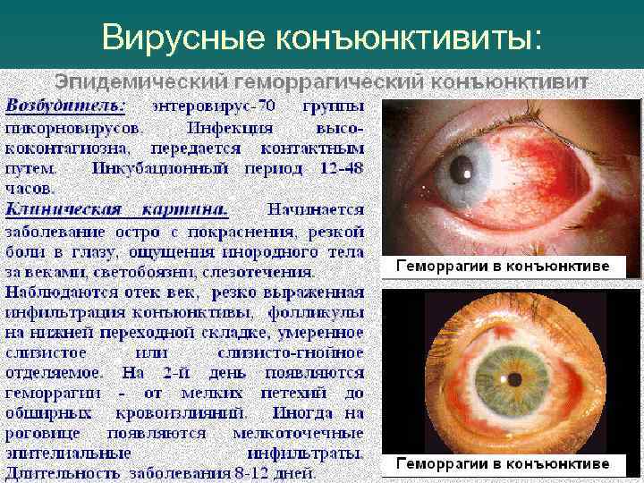Вирусные конъюнктивиты: 