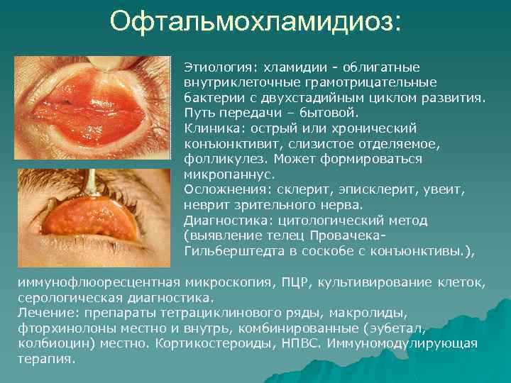 Офтальмохламидиоз: Этиология: хламидии - облигатные внутриклеточные грамотрицательные бактерии с двухстадийным циклом развития. Путь передачи