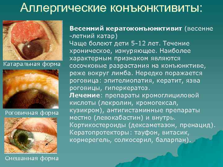 Аллергические конъюнктивиты: Катаральная форма Роговичная форма Смешанная форма Весенний кератоконъюнктивит (весенне -летний катар) Чаще