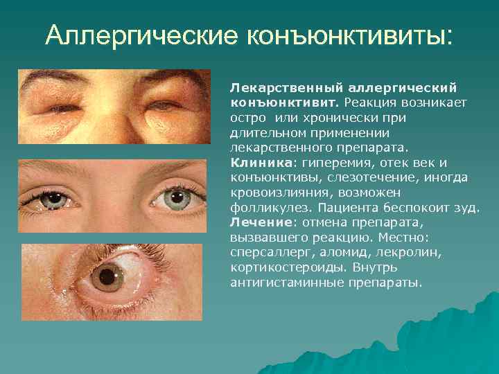 Аллергические конъюнктивиты: Лекарственный аллергический конъюнктивит. Реакция возникает остро или хронически при длительном применении лекарственного