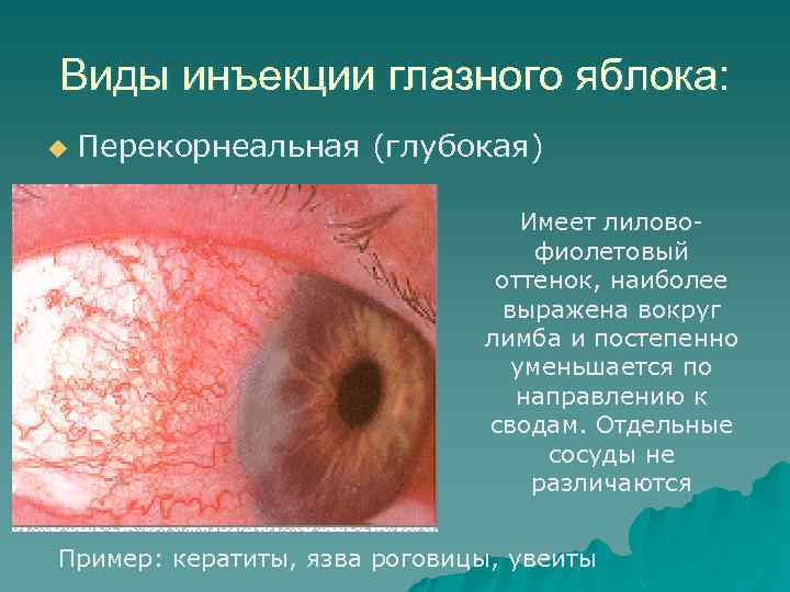 Виды инъекции глазного яблока: u Перекорнеальная (глубокая) Имеет лиловофиолетовый оттенок, наиболее выражена вокруг лимба