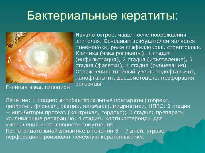 Бактериальные кератиты: Гнойная язва, гипопион Начало острое, чаще после повреждения эпителия. Основным возбудителем является