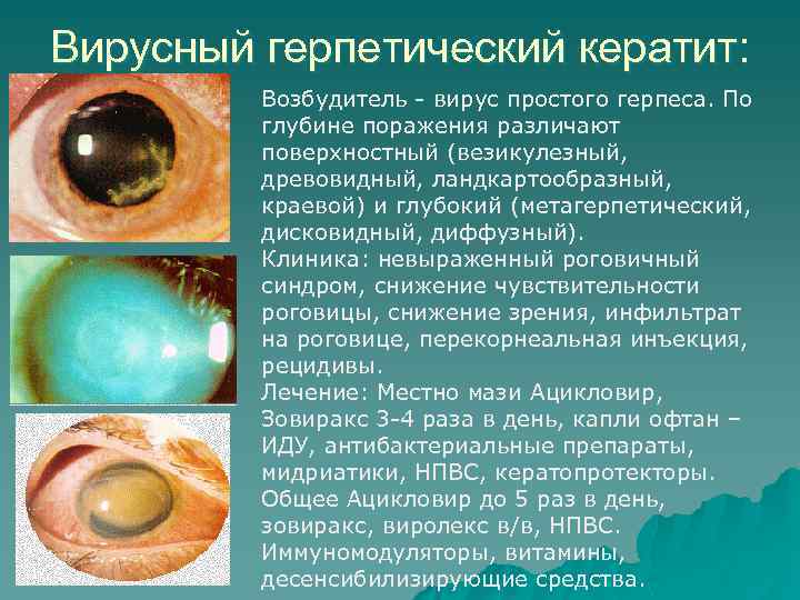 Вирусный герпетический кератит: Возбудитель - вирус простого герпеса. По глубине поражения различают поверхностный (везикулезный,