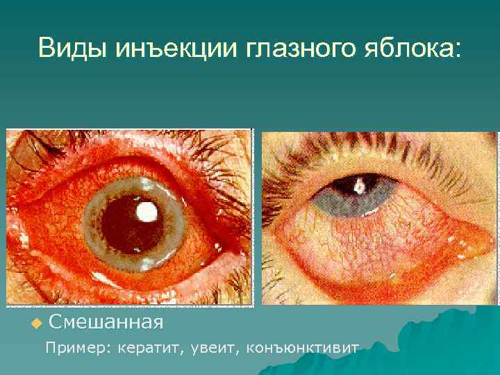 Виды инъекции глазного яблока: u Смешанная Пример: кератит, увеит, конъюнктивит 