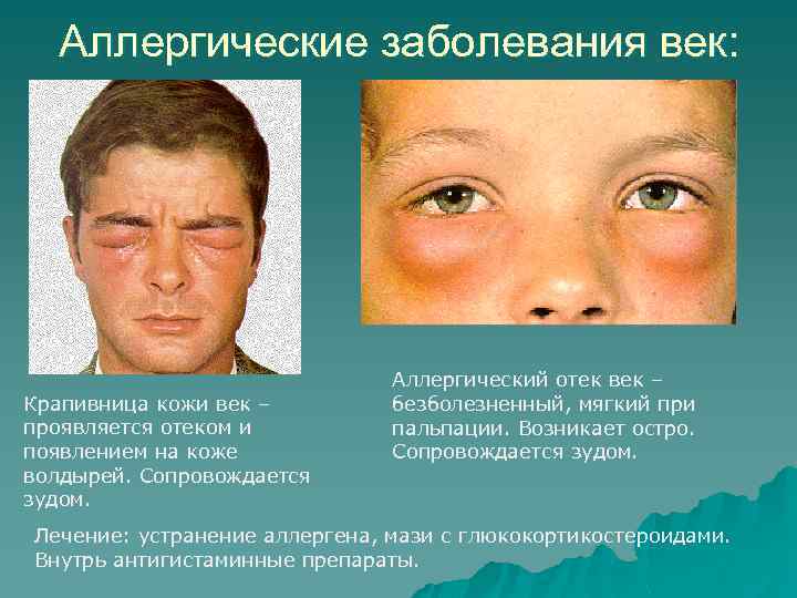 Аллергические заболевания век: Крапивница кожи век – проявляется отеком и появлением на коже волдырей.