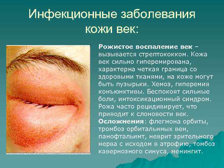 Инфекционные заболевания кожи век: Рожистое воспаление век – вызывается стрептококком. Кожа век сильно гиперемирована,