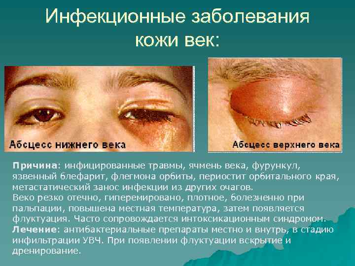 Инфекционные заболевания кожи век: Причина: инфицированные травмы, ячмень века, фурункул, язвенный блефарит, флегмона орбиты,