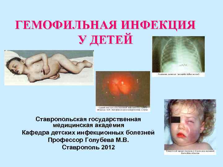 ГЕМОФИЛЬНАЯ ИНФЕКЦИЯ У ДЕТЕЙ Ставропольская государственная медицинская академия Кафедра детских ГЕМОФИЛЬНАЯ ИНФЕКЦИЯ У ДЕТЕЙ Ставропольская государственная медицинская академия Кафедра детских