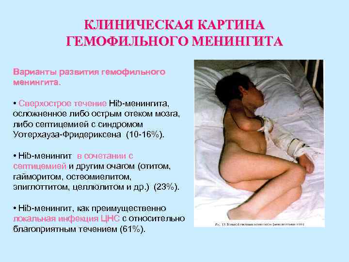 КЛИНИЧЕСКАЯ КАРТИНА ГЕМОФИЛЬНОГО МЕНИНГИТА Варианты развития гемофильного менингита. КЛИНИЧЕСКАЯ КАРТИНА ГЕМОФИЛЬНОГО МЕНИНГИТА Варианты развития гемофильного менингита.