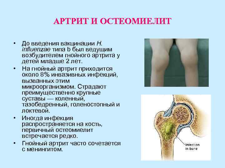 АРТРИТ И ОСТЕОМИЕЛИТ • До введения вакцинации H. influenzae типа АРТРИТ И ОСТЕОМИЕЛИТ • До введения вакцинации H. influenzae типа