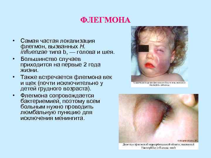 ФЛЕГМОНА • Самая частая локализация флегмон, вызванных H. ФЛЕГМОНА • Самая частая локализация флегмон, вызванных H.