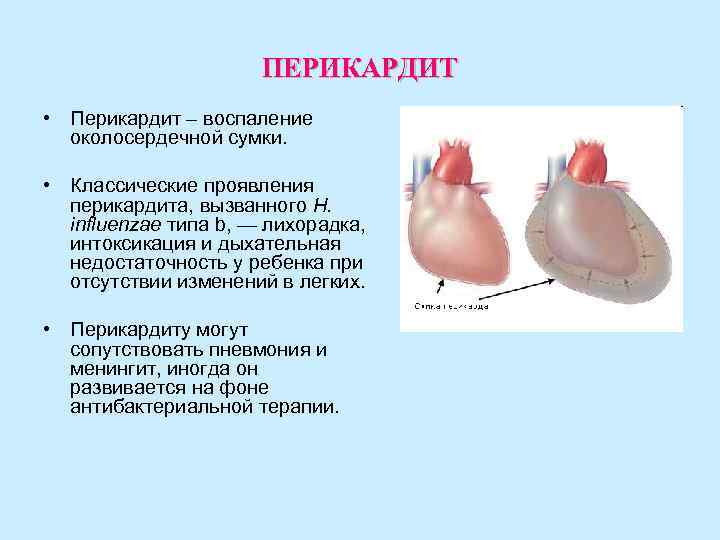 ПЕРИКАРДИТ • Перикардит – воспаление околосердечной сумки. ПЕРИКАРДИТ • Перикардит – воспаление околосердечной сумки.