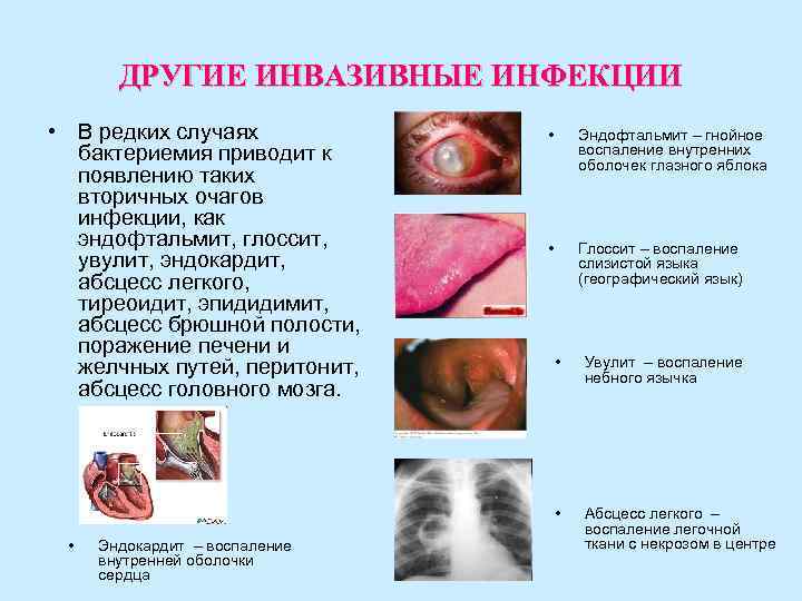 ДРУГИЕ ИНВАЗИВНЫЕ ИНФЕКЦИИ • В редких случаях • Эндофтальмит ДРУГИЕ ИНВАЗИВНЫЕ ИНФЕКЦИИ • В редких случаях • Эндофтальмит