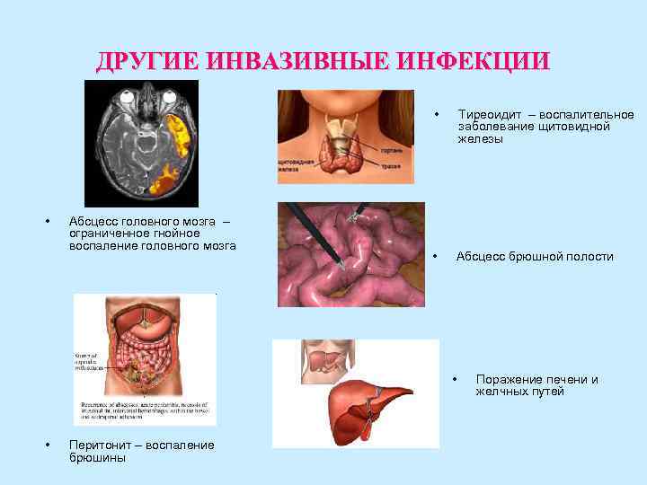 ДРУГИЕ ИНВАЗИВНЫЕ ИНФЕКЦИИ • Тиреоидит – ДРУГИЕ ИНВАЗИВНЫЕ ИНФЕКЦИИ • Тиреоидит –