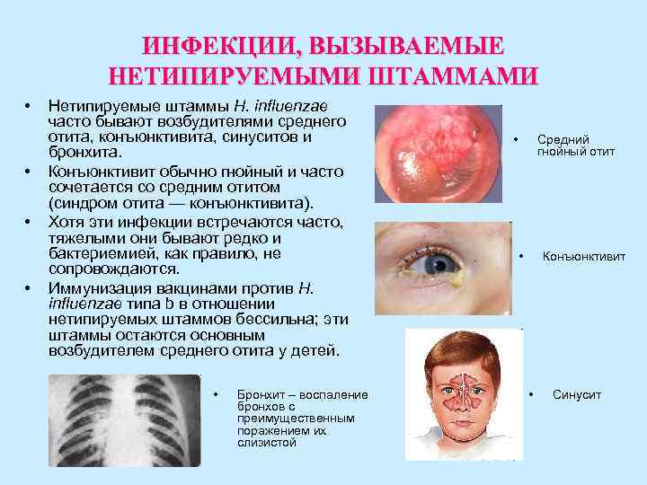 ИНФЕКЦИИ, ВЫЗЫВАЕМЫЕ НЕТИПИРУЕМЫМИ ШТАММАМИ • Нетипируемые штаммы H. influenzae ИНФЕКЦИИ, ВЫЗЫВАЕМЫЕ НЕТИПИРУЕМЫМИ ШТАММАМИ • Нетипируемые штаммы H. influenzae