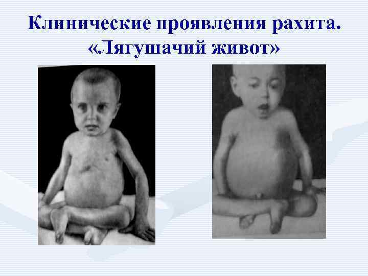 Клинические проявления рахита.  «Лягушачий живот» 