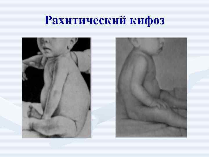 Рахитический кифоз 