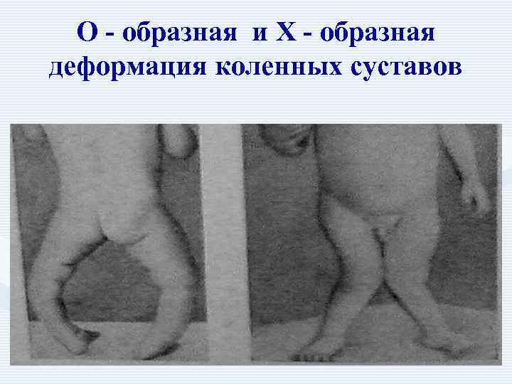  О - образная и Х - образная  деформация коленных суставов 