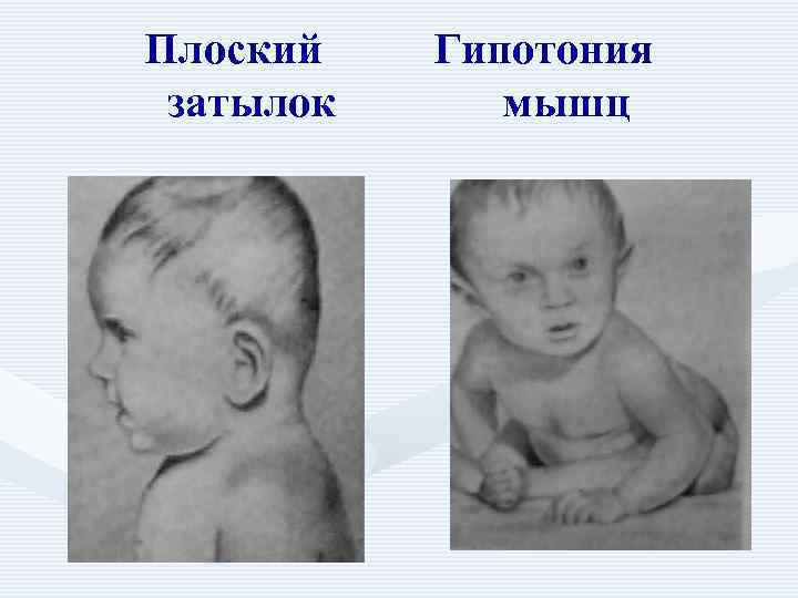 Плоский   Гипотония затылок    мышц 