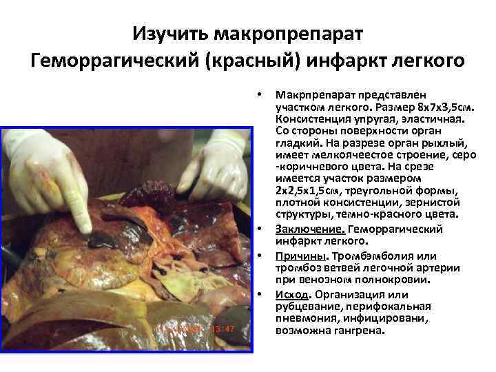    Изучить макропрепарат Геморрагический (красный) инфаркт легкого    • 