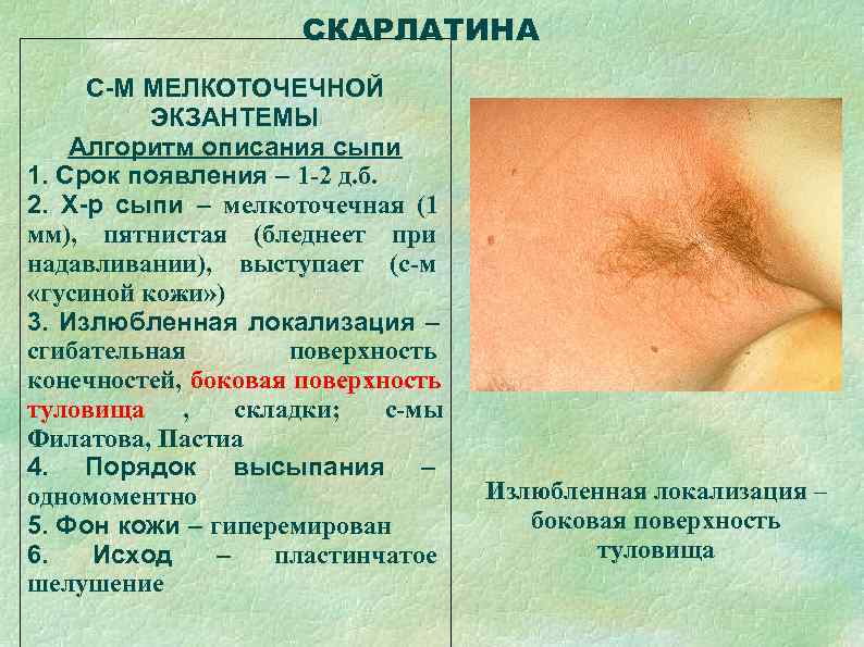      СКАРЛАТИНА С-М МЕЛКОТОЧЕЧНОЙ  ЭКЗАНТЕМЫ Алгоритм описания сыпи 1.