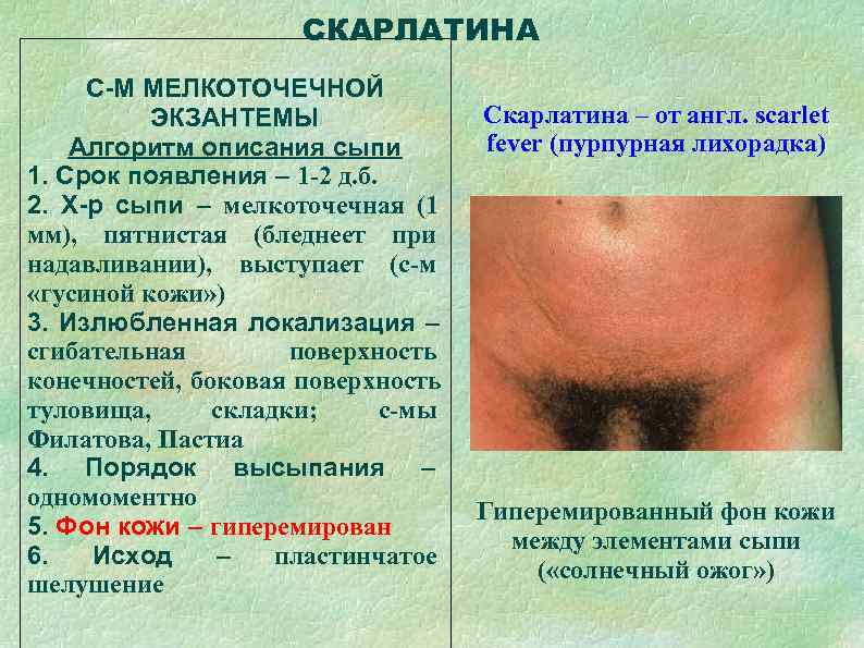      СКАРЛАТИНА С-М МЕЛКОТОЧЕЧНОЙ  ЭКЗАНТЕМЫ   Скарлатина –
