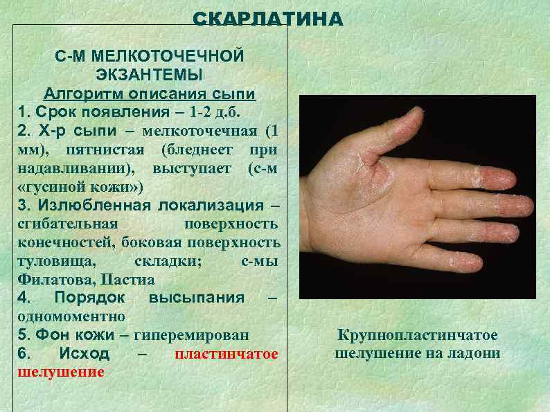      СКАРЛАТИНА С-М МЕЛКОТОЧЕЧНОЙ  ЭКЗАНТЕМЫ Алгоритм описания сыпи 1.