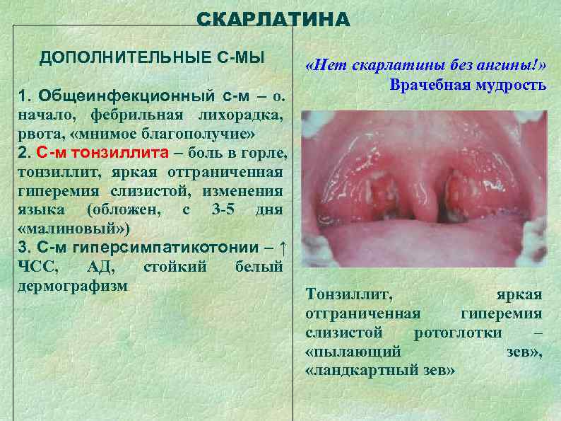      СКАРЛАТИНА  ДОПОЛНИТЕЛЬНЫЕ С-МЫ    «Нет скарлатины