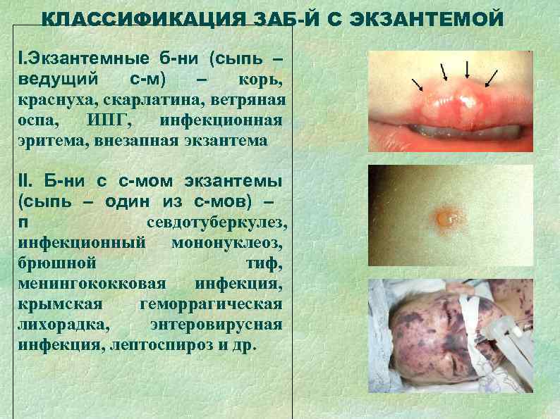  КЛАССИФИКАЦИЯ ЗАБ-Й С ЭКЗАНТЕМОЙ I. Экзантемные б-ни (сыпь – ведущий с-м)  –