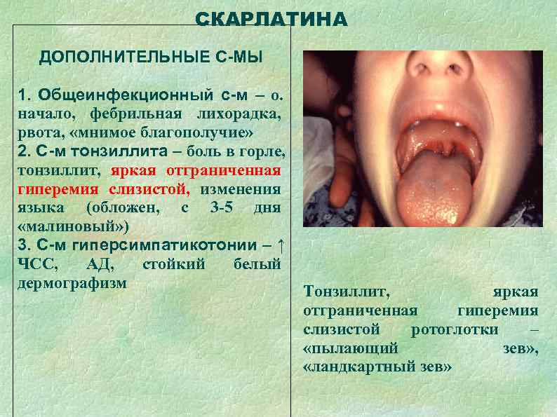      СКАРЛАТИНА  ДОПОЛНИТЕЛЬНЫЕ С-МЫ 1. Общеинфекционный с-м – о.