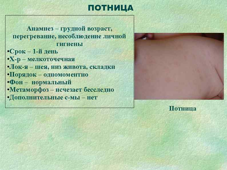     ПОТНИЦА   Анамнез – грудной возраст,  перегревание, несоблюдение