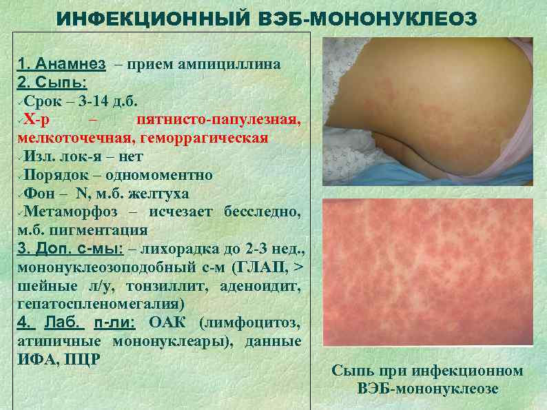  ИНФЕКЦИОННЫЙ ВЭБ-МОНОНУКЛЕОЗ 1. Анамнез – прием ампициллина 2. Сыпь:  Срок – 3