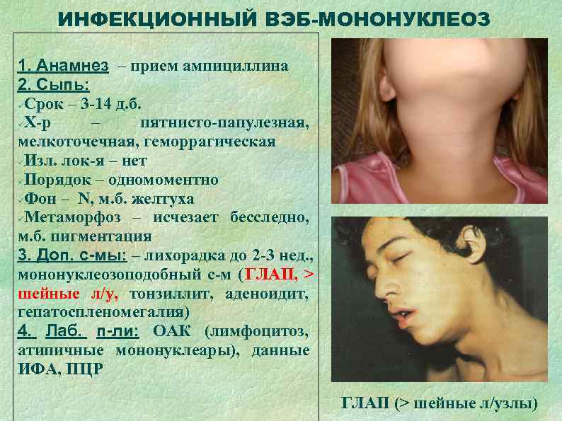  ИНФЕКЦИОННЫЙ ВЭБ-МОНОНУКЛЕОЗ 1. Анамнез – прием ампициллина 2. Сыпь:  Срок – 3